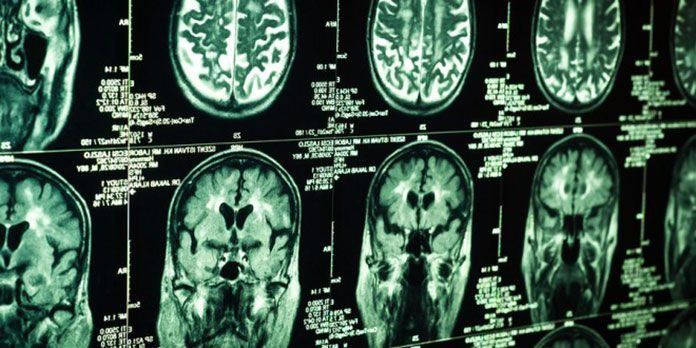 New Technology could Deliver Drugs to Brain Injuries
