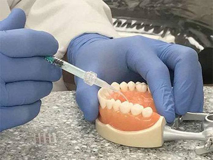 New Cavity Treatment Offer No Drilling, No FIlling
