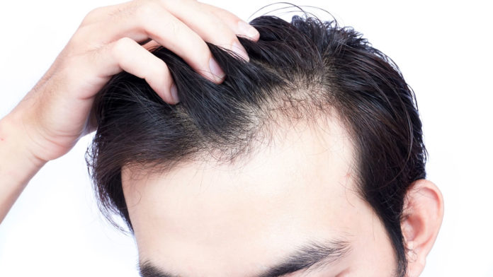 Scientists Discovered The Mechanism Behind Gray Hair And Baldness