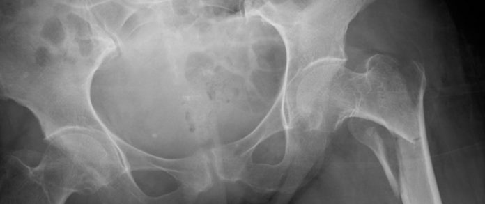 Osteoporosis-Related Bone Fractures Linked to Air Pollution