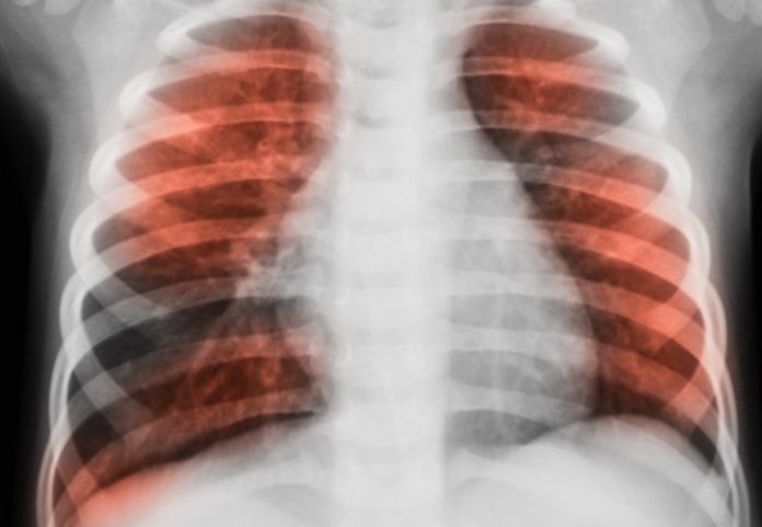 Glucose in the airways could increase infections in lung disease patients