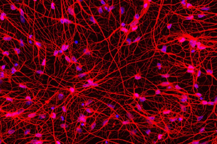 Scientists says, transformation of Huntington’s disease patients’ skin cells into brain cells sheds light on disorder