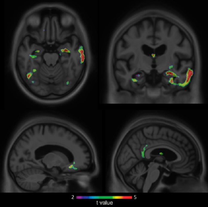 brain imaging result