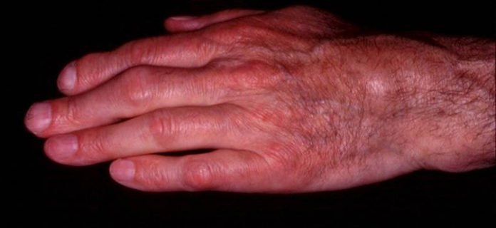 The hand of an adult patient suffering from Still’s disease