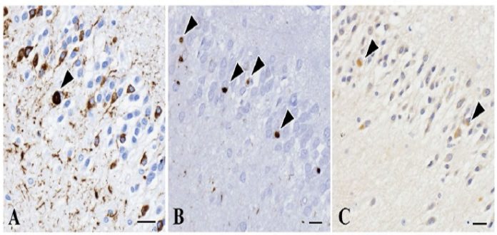 Tau proteins accumulated in the brain of a patient with PSP-like symptoms. (Yabe I. et al., Scientific Reports, January 16, 2018)