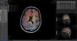 AI software to check brain health
