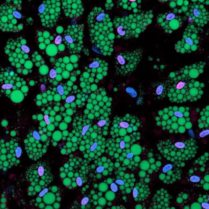 Confocal fluorescent micrograph of human adipose stem/precursor cells (ASPCs) differentiated into white adipocytes in vitro. Accumulated lipid droplets are visualised in green by Bodipy staining and nuclei in blue with Hoechst. Pink staining shows the presence of the adipogenic transcription factor (CEBPβ), activation of which gives rise to adipogenic phenotype, which here is visualised by the intensity of the CEBPβ signal. (EPFL / Laboratory of Systems Biology & Genetics / Magda Zachara.)