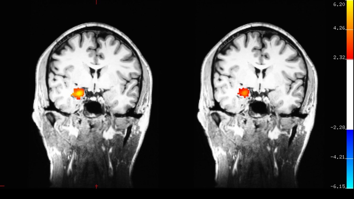 Functional MRI (left) showing activation in the amygdala when participants were watching images with emotional content before learning meditation. After eight weeks of training in mindful attention meditation (right) note the amygdala is less activated after the meditation training. Courtesy of Gaelle Desbordes
