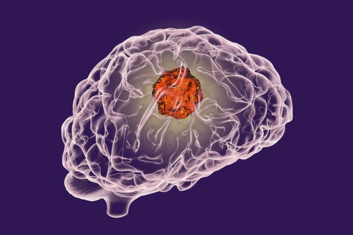 Brain cancer, 3D illustration showing presence of tumor inside brain