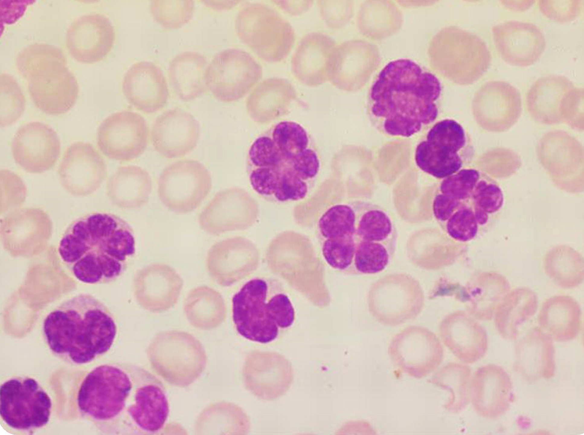 HTLV-1 leukaemic cells: Once the infected T-cells are infected and progress to leukaemia they are often called ‘flower cells’ due to their shape (Image: Blood 2010; vol. 115, p.1668)