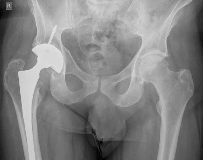 X-ray showing lytic area medial wall right acetabulum adjacent to the acetabular cup of a total hip replacement. ?osteolysis ?neoplasia.