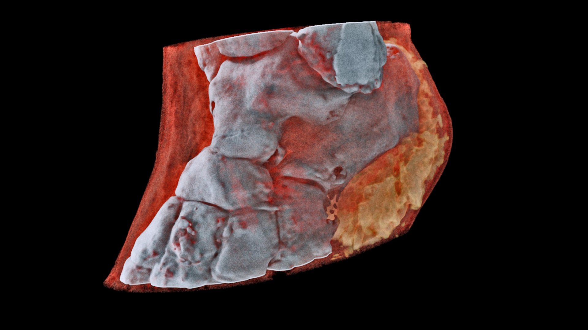 A 3D MARS image of an ankle viewed front on where the soft tissue (coloured in red) has been made translucent to show the bones (white) and  lipid-like material (yellow) inside the ankle.
