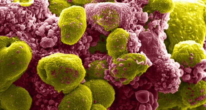 In this electron micrograph, prostate tumor cells dying from a type of programmed cell death called apoptosis are shown (purple) alongside healthy cancer cells (yellow). Scientists are learning more about how apoptosis spreads through cells.