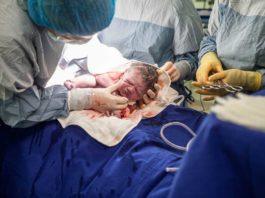 The global rate of C-section doubled from 2000 to 2015 and now accounts for more than 1 in 5 live births.