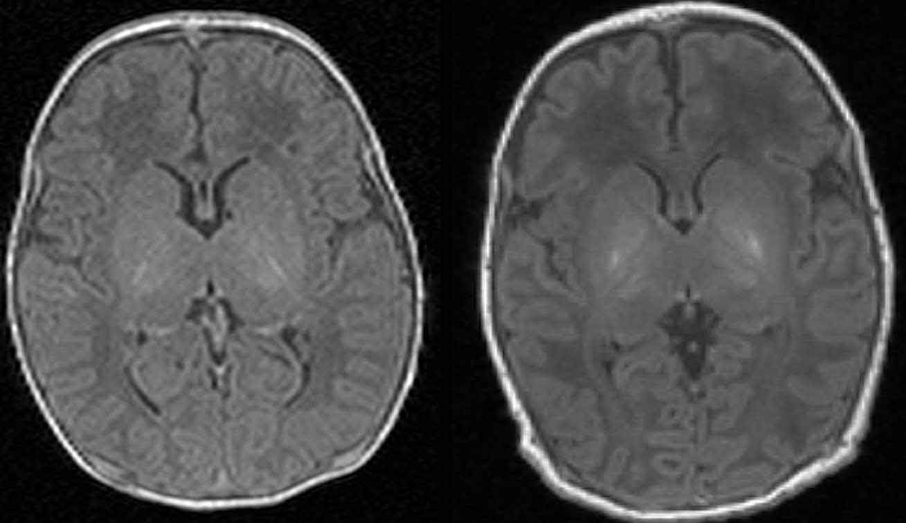 Scan one (left) shows the brain of a healthy baby, while scan two (right) shows that of a baby with brain damage. Compared to scan one, scan two shows abnormal brightness in the deep nuclei (in the centre of the brain), which indicates damage
