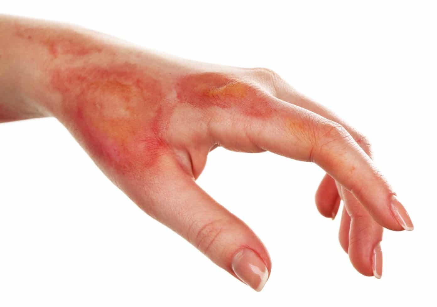 A Non Invasive Method Developed To Assess Burn Wound Healing