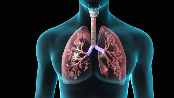 New tool to identify which patients with COPD are at risk of death