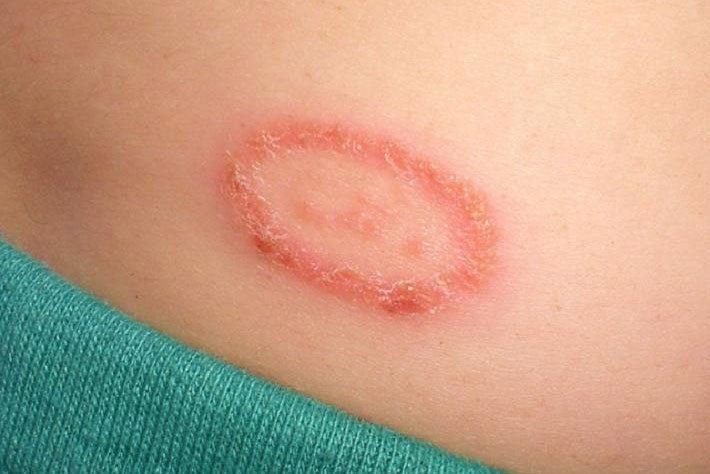 Poor quality of drugs making treatment of ringworm less effective ...