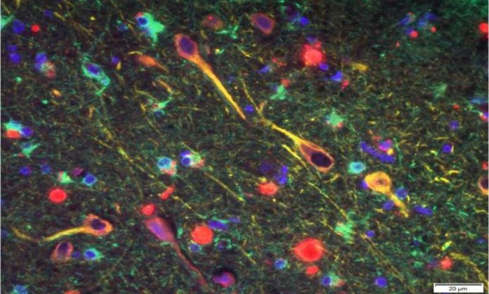 Image of P. gingivalis' gingipains in the neurons of Alzheimer's brain. P. gingivalis gingipains = red, neurons = yellow, astrocytes = green. Credit: Cortexyme, Inc.