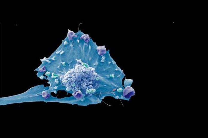 Breast cancer cell Credit: Anne Weston, Francis Crick Institute