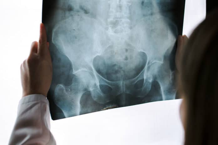 Gene map could unlock new treatments for osteoporosis