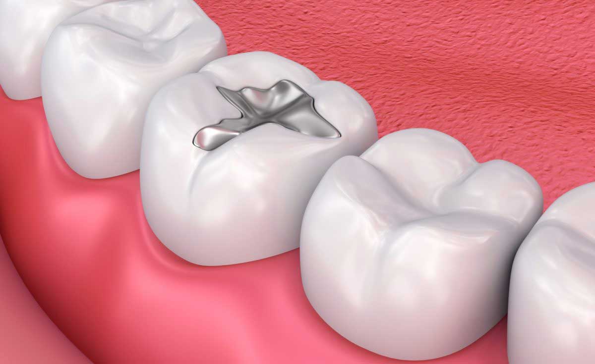 New bioactive dental filling material promises to be teeth-friendly