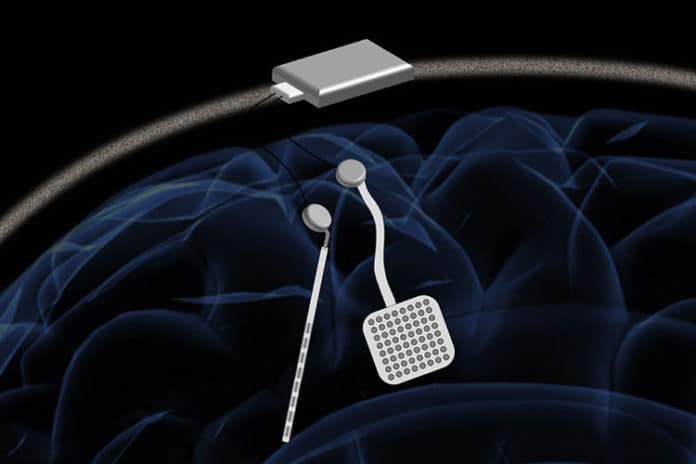 In a proposed device, two of the new chips would be embedded in a chassis located outside the head. Each chip could monitor electrical activity from 64 electrodes located into the brain while simultaneously delivering electrical stimulation to prevent unwanted seizures or tremors. (credit: Rikky Muller, UC Berkeley)