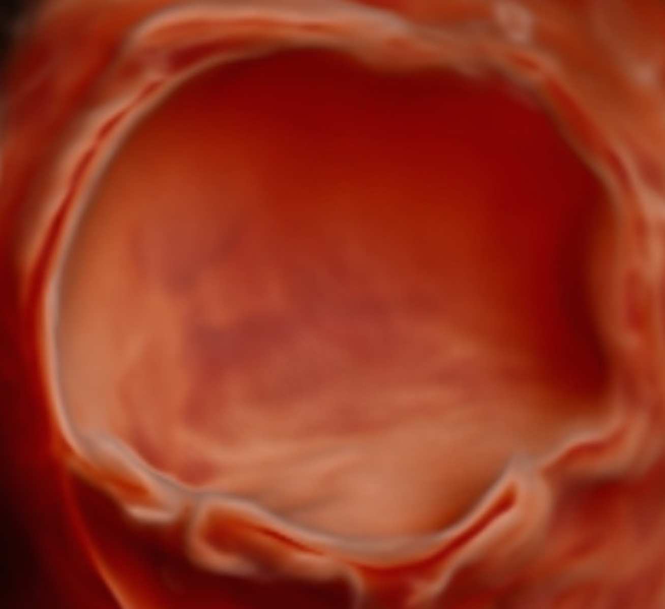 Benign (non-cancerous) ovarian cyst, viewed using ultrasound