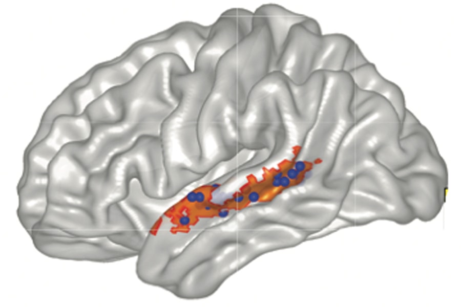 An illustration shows functional connectivity between the posterior striatum and speech-selective left superior temporal sulcus tissue. l-STS tissue was identified as exhibiting greater BOLD activation for hearing speech compared with nonspeech sounds (i.e., speech: English words and syllables vs. nonspeech: semantically matched environmental sounds and sound exemplars from the videogame) in a separate localizer task before videogame training. The group-based speech > nonspeech contrast mask is shown in orange, and individually defined speech-selective ROIs are shown as blue spheres.