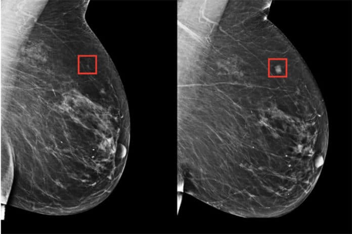 MIT/MGH AI model identified woman at high risk 4 years (left) before her breast cancer (right)/ Image Credit: MIT CSAIL