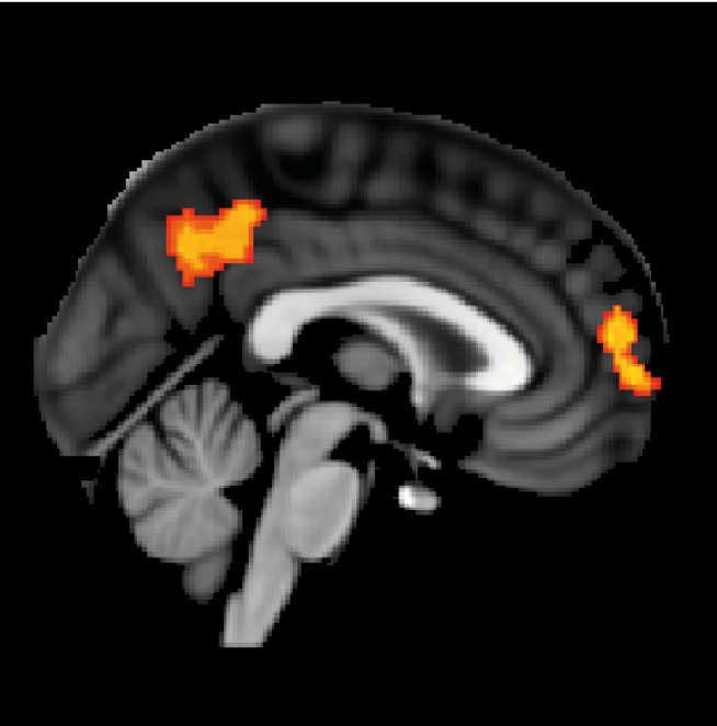 White matter affects how people respond to brain stimulation therapy