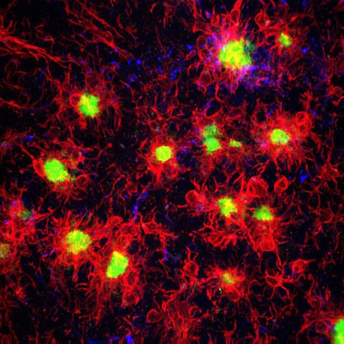Microglia, shown in red, surround and react to the amyloid-beta plaques, shown in green, in the Alzheimer's disease brain. CREDIT Kim Green lab / UCI