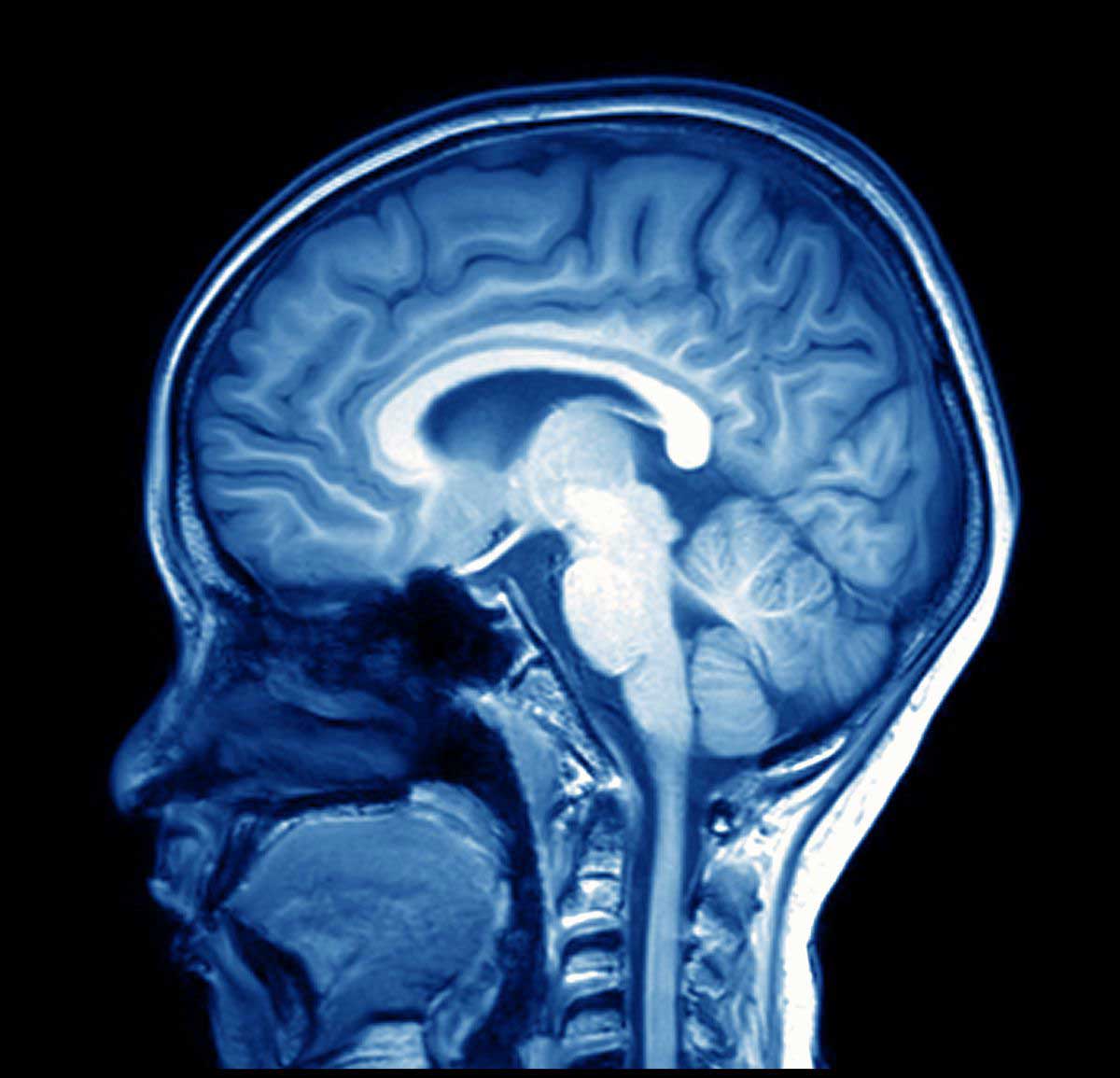 Advanced MRI brain scan analysis may help predict stroke-related dementia