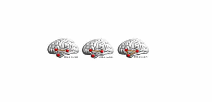 Illustration of the three brain regions associated with speech production and the networks between them that, when broken, lead to speech impairments. Solid orange lines depict significantly lower connectivity between brain regions (in red) in PPA. IFG = Inferior Frontal Gyrus; MTG = Middle Temporal Gyrus; ATL = Anterior Temporal Lobe. PPA = Primary Progressive Aphasia; PPA-G = Nonfluent/agrammatic variant of PPA; PPA-L = Logopenic variant of PPA; PPA-S = Semantic variant of PPA.