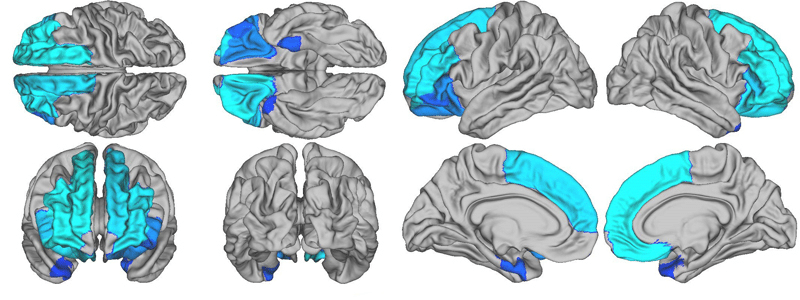 Image: The brain areas highlighted in blue represent regions where cortical thickness is related to BMI. The lighter the blue, the more pronounced the relationship – in other words, the thinner the cortex is in children with a higher BMI. (Credit: Lisa Ronan, University of Cambridge)