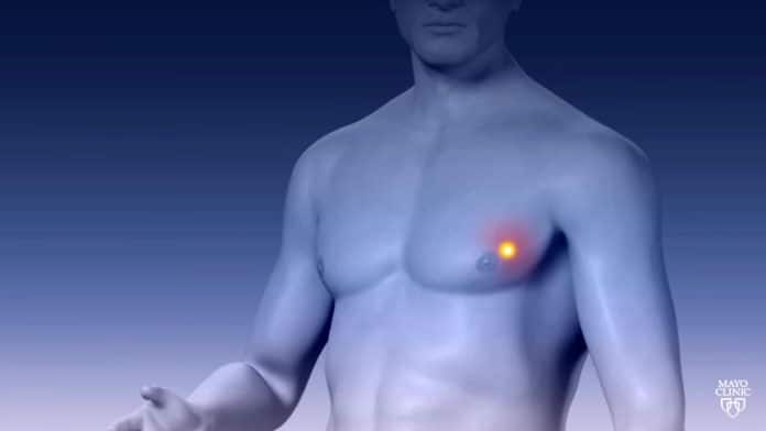 Male breast cancer: Study offers insight on treatment and prognosis