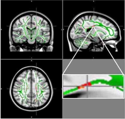 Reduction in fractional anisotropy (FA) in obese patients compared to the control group: At the intersection of the alignment vectors, a large cluster of FA decrease located in the corpus callosum on the left. In red: Reduction of FA in obese patients compared to controls, and FA skeleton (green), superimposed on the mean of FA images in sample
