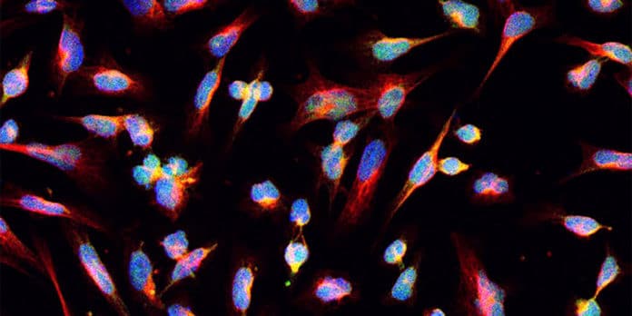 Image shows glioma cancer cells
