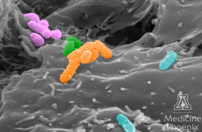 Pseudocolored scanning electron microscopy image of human 3-D cervical epithelial cells infected with a polymicrobial cocktail of four key bacterial species associated with bacterial vaginosis. CREDIT Image Courtesy of Dr. Melissa Herbst-Kralovetz Lab, UArizona College of Medicine - Phoenix.