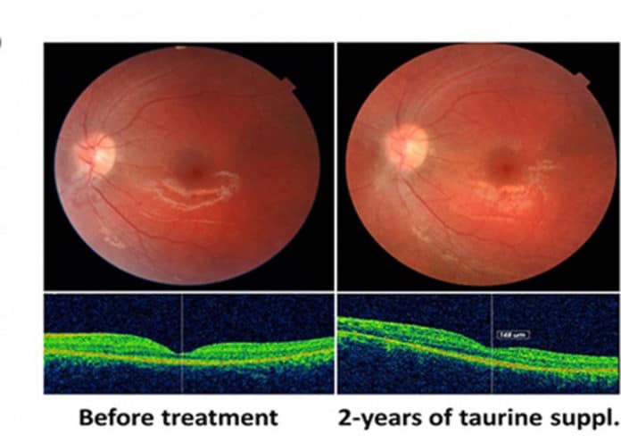 Photographs of the patient’s left fundus at baseline and after 24 months of taurine supplementation, showing anatomical stability with photoreceptor preservation. © UNIGE