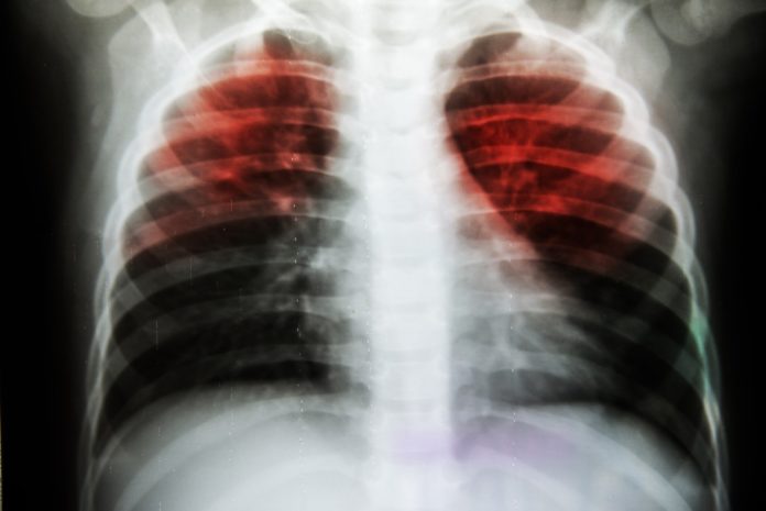 Indian scientists discovered a new way to fight TB