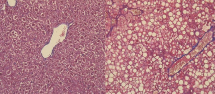 Liver cells under microscopy. At the top, in a healthy liver, the liver cells are organized normally. At the bottom, an accumulation of fat (white circles) is visible. © UNIGE