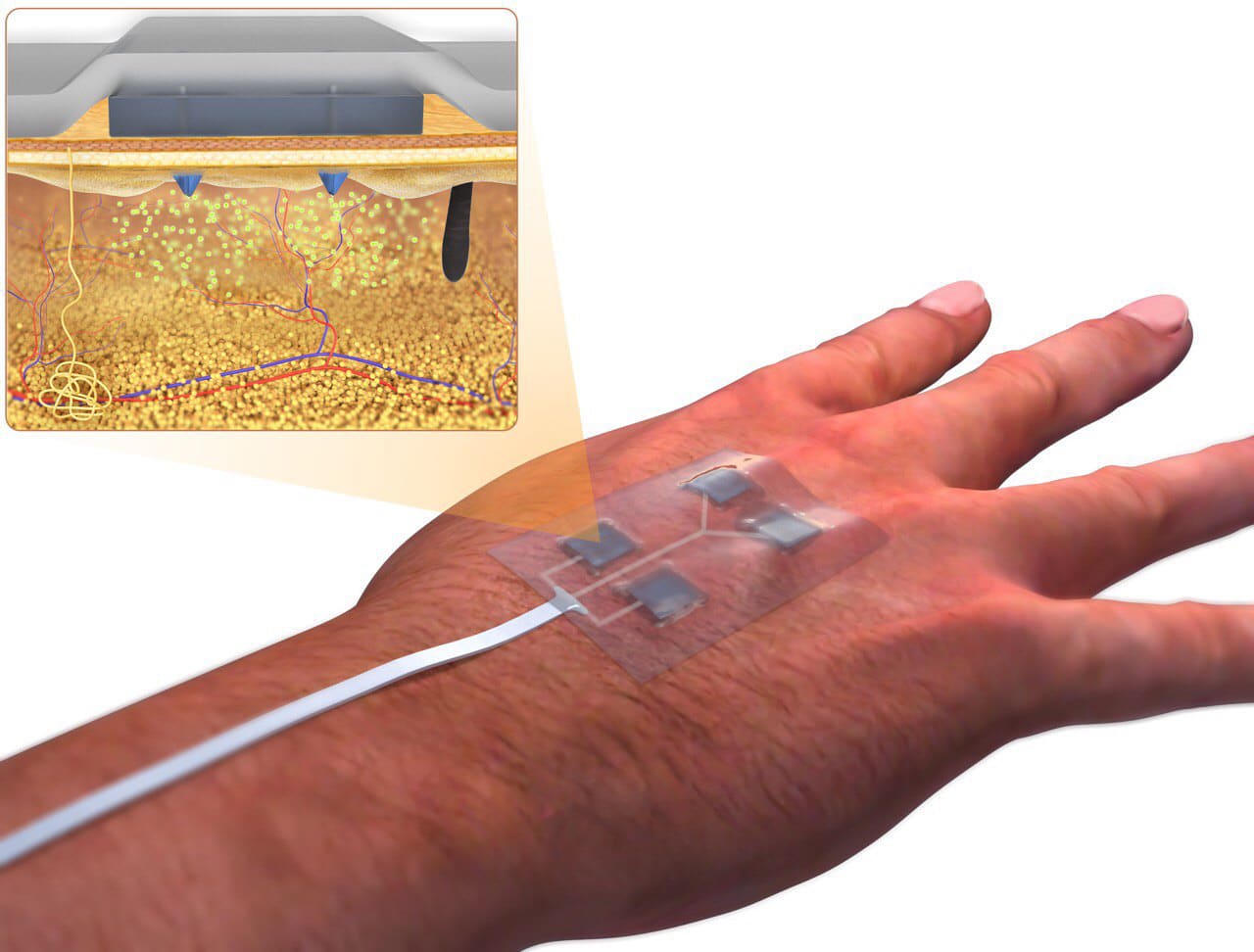 new "smart bandage" that could improve clinical care.