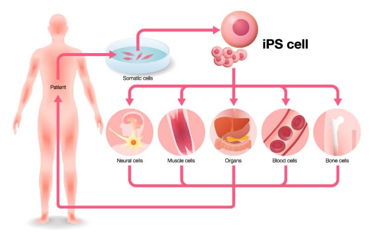 nduced pluripotent stem cells (iPSCs) can transform into any cell in the body.