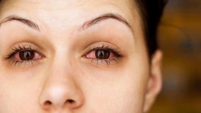 The pink eye as a primary symptom of COVID-19