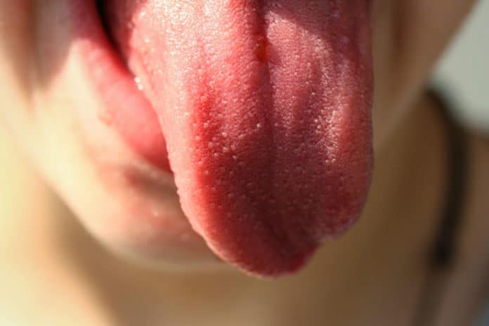 Microorganisms on the tongue could help diagnose heart failure