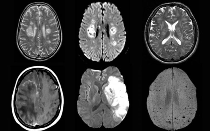 Covid-19 can cause delirium, brain inflammation