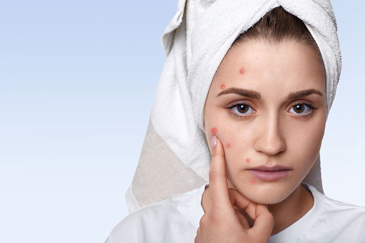 Anatomy of an acne treatment