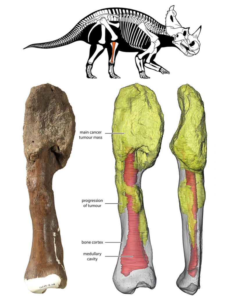 The main tumour mass is at the top of the bone, and can be seen on the 3D reconstruction in yellow; red gray is the normal bone and red denotes the medullary cavity.