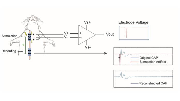Illustration of the operation of a stimulus artifact suppression algorithm in eCAP traces. A custom-made buffer amplifier is used to record the developed voltage on the stimulating electrode. An offline algorithm aligns and adjusts the stimulation voltage amplitude to match that of the corresponding voltage deflection in the eCAP (arrow in middle panel), and subtracts the 2 traces to suppress the stimulus artifact.
